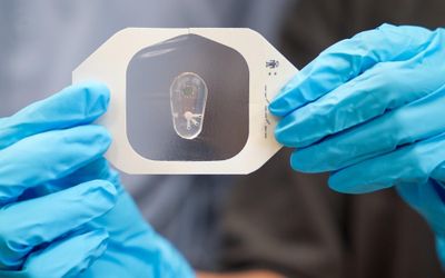 Breaking a sweat: Using chloride in sweat to help diagnose cystic fibrosis