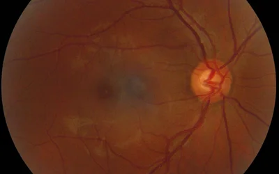 Computer Vision Inspecting the Human Eye