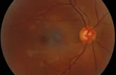 Computer Vision Inspecting the Human Eye