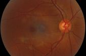 Computer Vision Inspecting the Human Eye