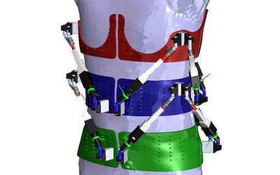 First Dynamic Spine Brace-Robotic Spine Exoskeleton-Characterizes Spine Deformities