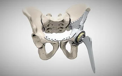 Custom 3D Printed Medical Devices: Trends and Opportunities