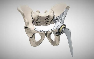 Custom 3D Printed Medical Devices: Trends and Opportunities
