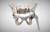 Custom 3D Printed Medical Devices: Trends and Opportunities