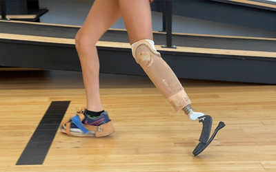 Revolutionizing prosthetics for kids: A modular approach that grows with the user