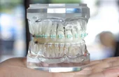 LightForce Orthodontics Brings to Market Fully-Custom Dental Braces