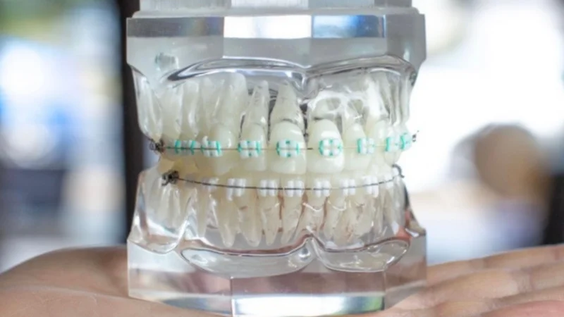 LightForce Orthodontics Brings to Market Fully-Custom Dental Braces