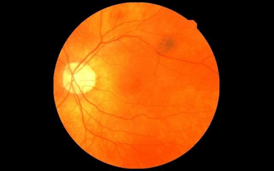 Can Retinal Scans Help in Predicting Myocardial Infarction?