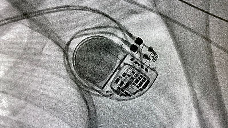 The Heartbeat of Innovation: How the RV-5028-C7 Medical RTC Module Powers the Next Generation of Implantable Medical Devices