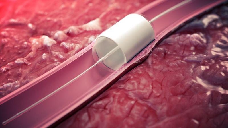 STENTiT:  Regenerating artery health right on High Tech Campus