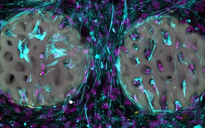 Is the bone implant of the future a hydrogel?