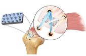New Device Inspired by Python Teeth Doubles Strength of Rotator Cuff Repairs